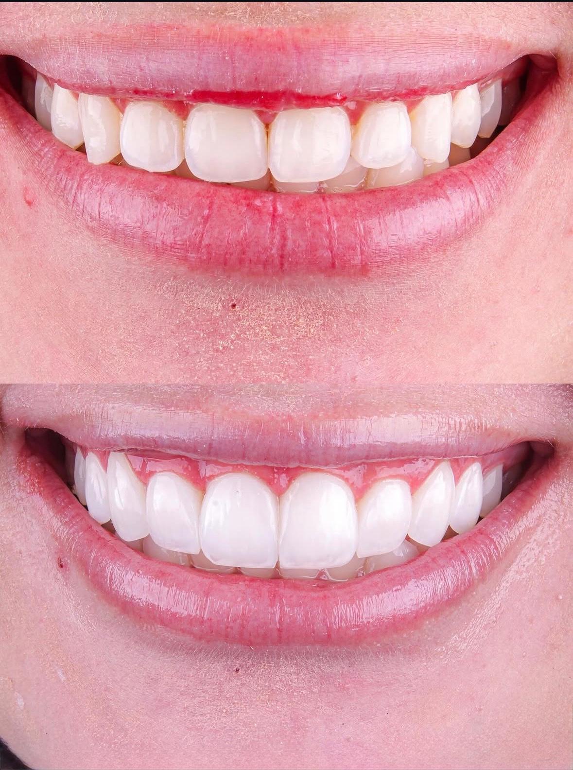 Caso 07 — Facetas Estéticas — antes e depois