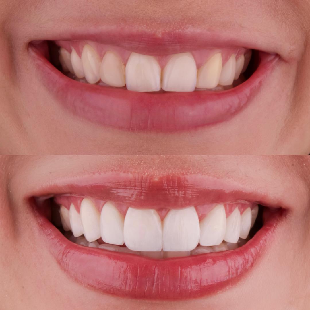 Caso 03 — Harmonização do Sorriso — antes e depois