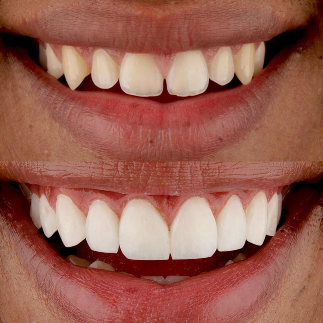 Caso 04 — Fechamento de Diastema — antes e depois